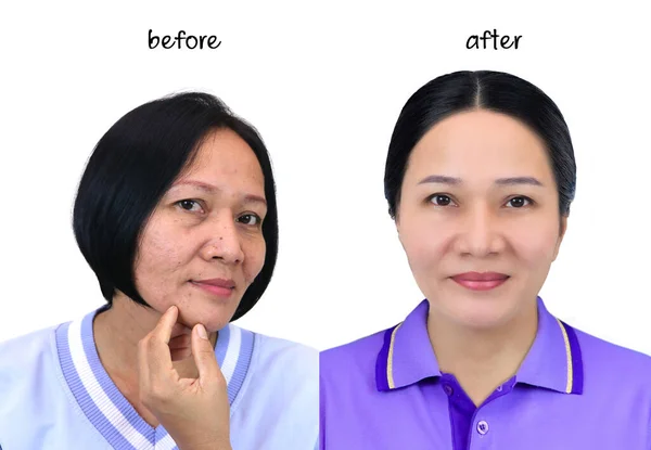 Asijská Žena Středního Věku Před Retuš Make Nebo Plastická Chirurgie — Stock fotografie