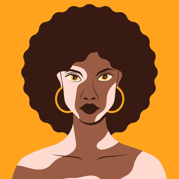 Belle Femme Africaine Peau Noire Avec Peau Pigment Vitiligo Afro — Image vectorielle