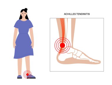 Aşil tendon hasarı