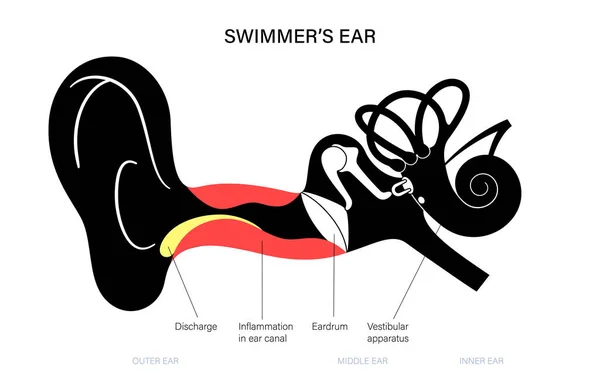 Otitis van het oor van zwemmers — Stockvector