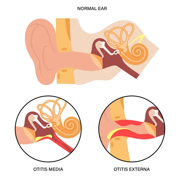 Externa media otitis — Stock Vector