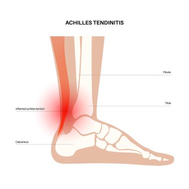 Aşil tendon hasarı