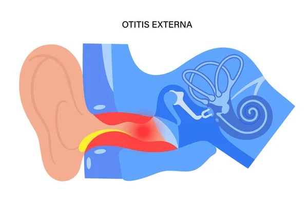 Swimmers ear otitis — Stock Vector