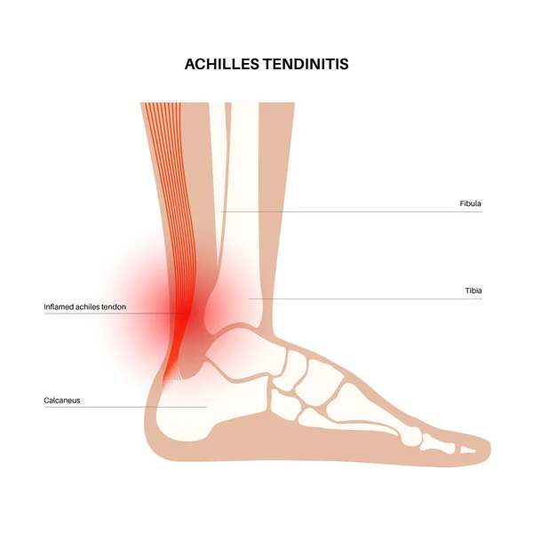 Achilles tendon injury — Stock Vector