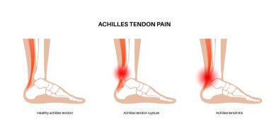 Aşil tendon hasarı