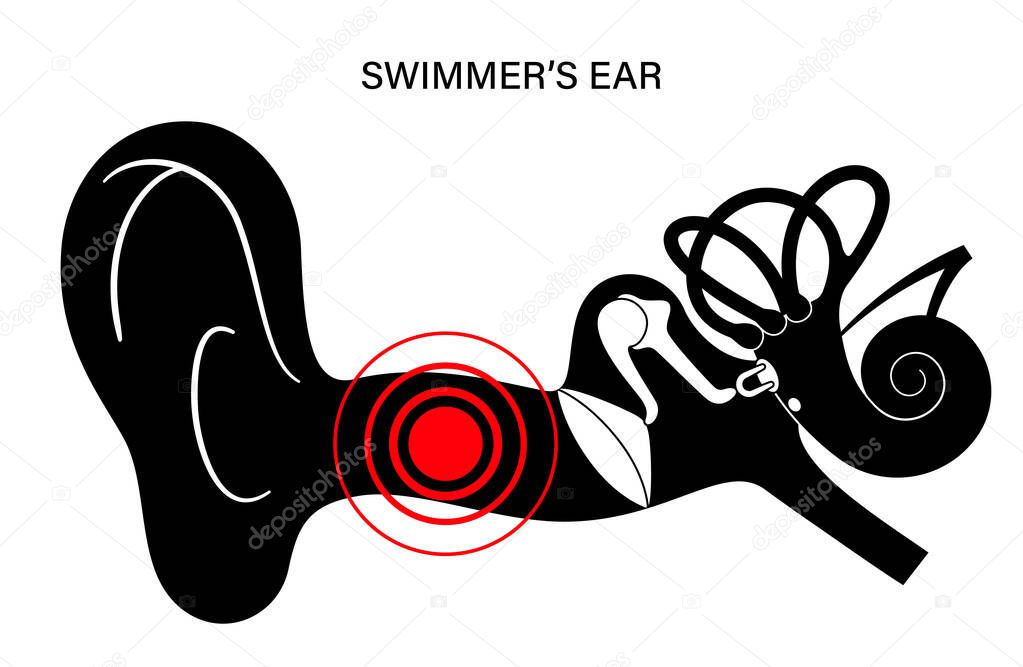 Swimmers ear otitis