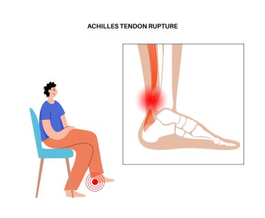 Aşil tendon hasarı
