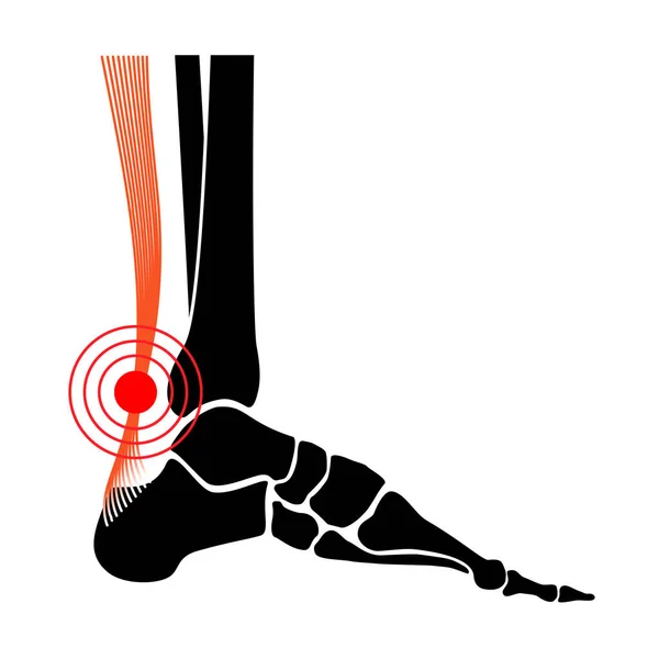 Aşil tendon hasarı — Stok Vektör