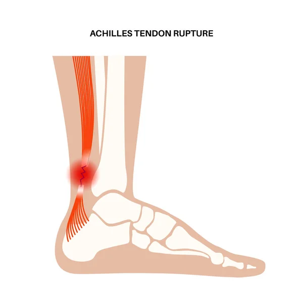 Aşil tendon hasarı — Stok Vektör