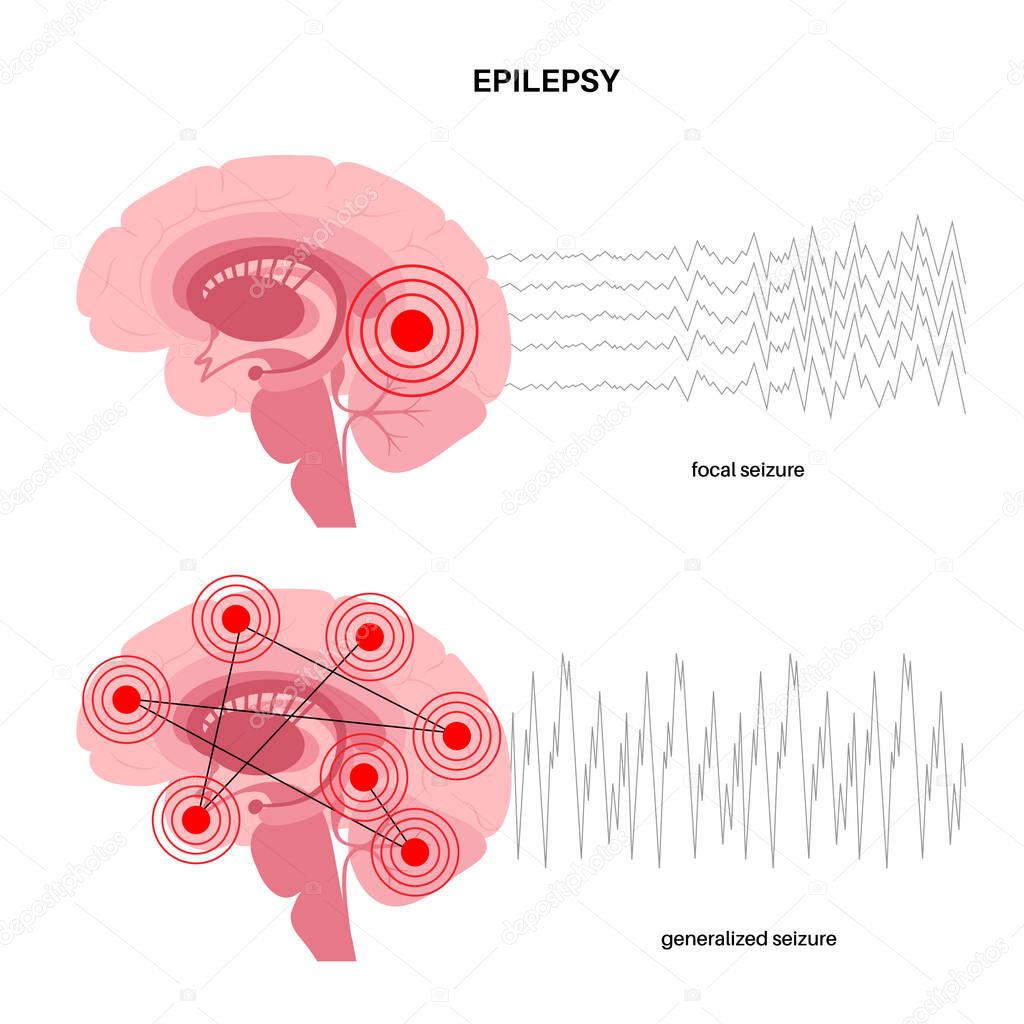 Generalized and partial seizure. Epilepsy and abnormal brain activity. Pain, spasm, migraine, headache or stress in human head. CNS disorder. Mental health clinic. Medical research vector illustration