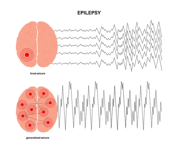 Epilepszia görcsroham koncepciója — Stock Vector