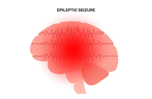 Epilepsia concepto de convulsiones — Vector de stock