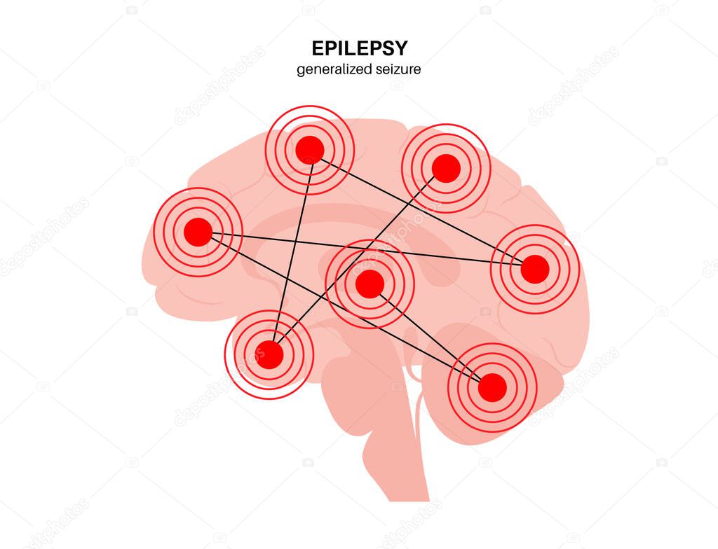 Generalized seizure. Epilepsy disease concept. Abnormal brain activity. Pain or spasm in human head. Central nervous system disorder. Mental health clinic. Medical research flat vector illustration.