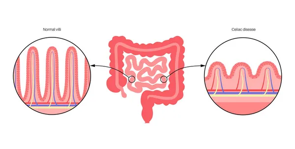 Infiammazione celiaca — Vettoriale Stock