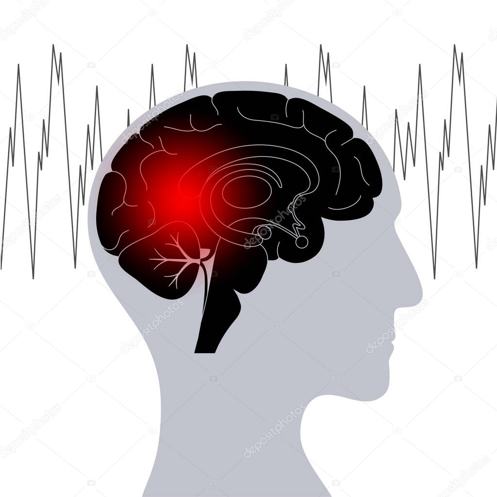 Generalized or partial seizure. Epilepsy and abnormal brain activity. Pain, spasm, migraine, headache or stress in human head. CNS disorder. Mental health clinic. Medical research vector illustration.