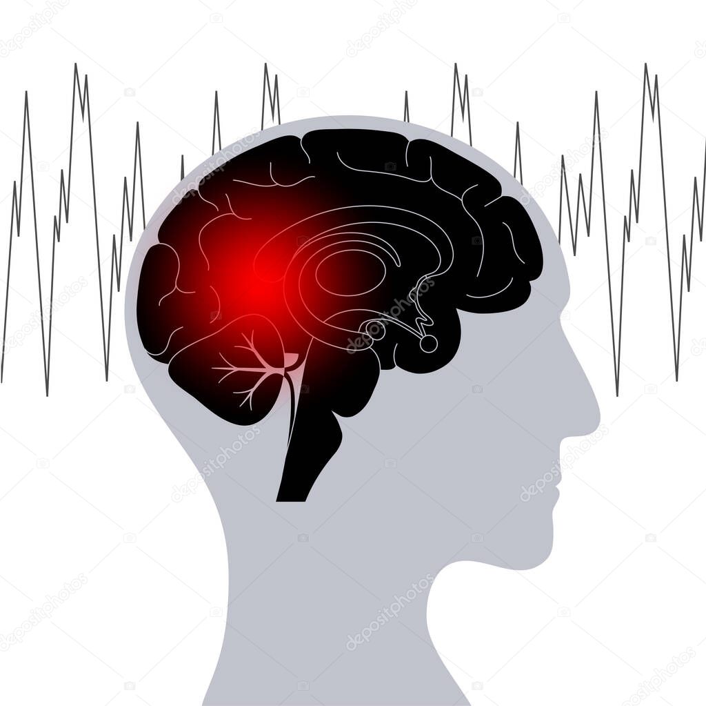 epilepsy seizure or headache