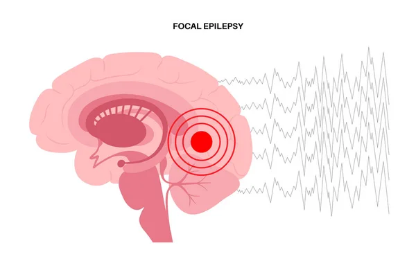 Konzept für epileptische Anfälle — Stockvektor