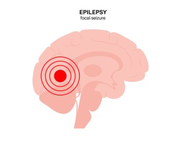 Epilepsi nöbeti kavramı