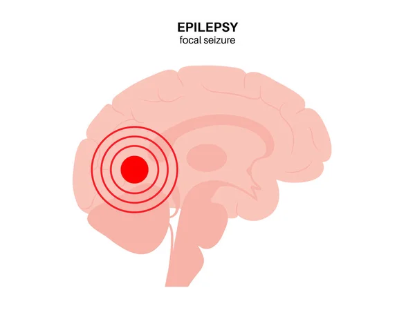 Epilepsy seizure concept — Stock Vector