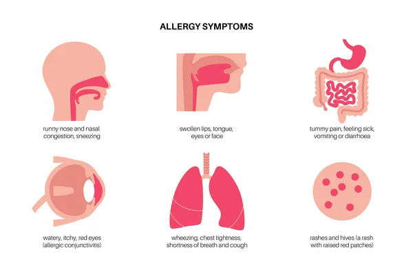 Alerji Belirtileri — Stok Vektör