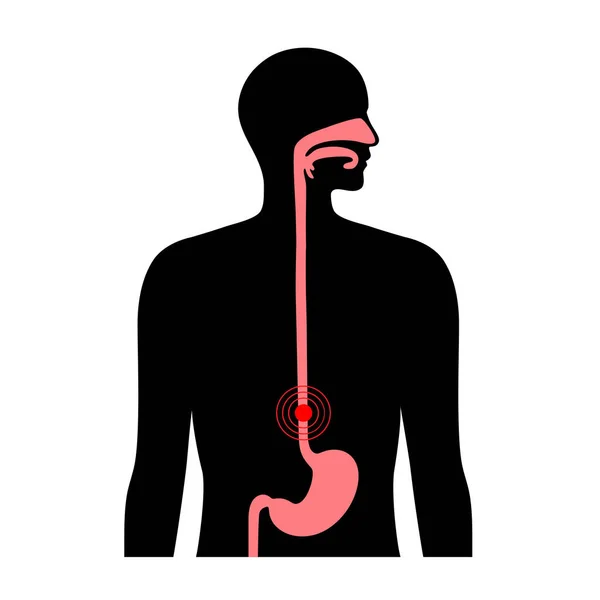 Gastro-oesofageale refluxziekte — Stockvector