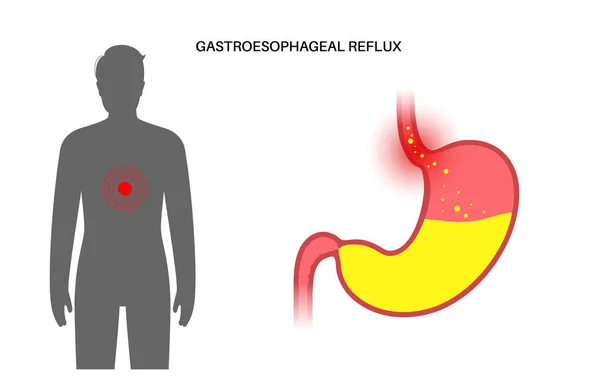 Enfermedad por reflujo gastroesofágico — Archivo Imágenes Vectoriales