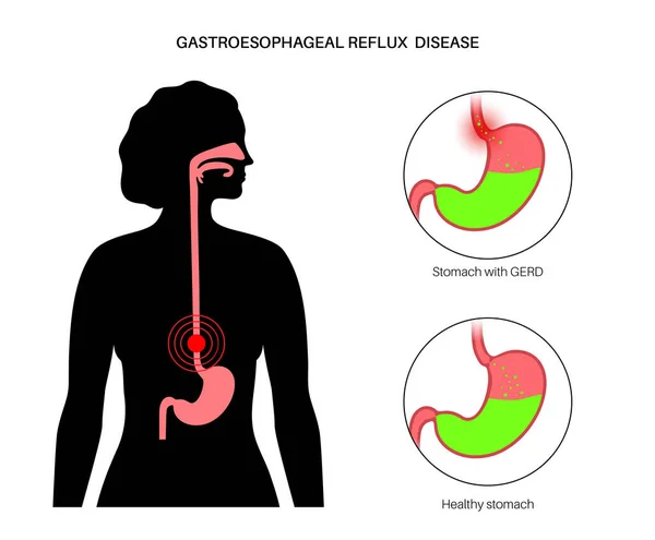 Gastroözofageal reflü hastalığı — Stok Vektör