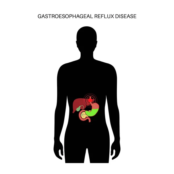 Malattia da reflusso gastroesofageo — Vettoriale Stock