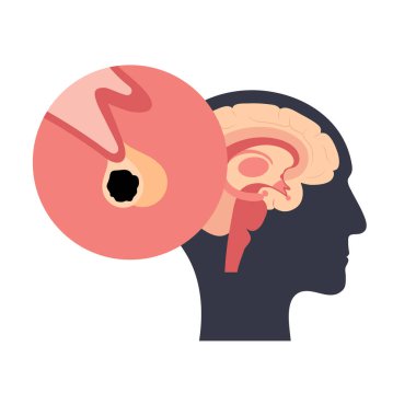 Hipofiz bezi kanseri.