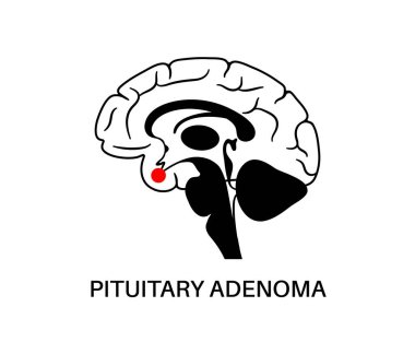 Hipofiz bezi kanseri.
