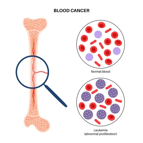 Enfermedad por cáncer de leucemia — Vector de stock