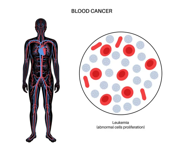 Leucemia malattia del cancro — Vettoriale Stock