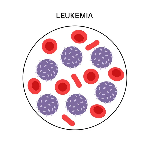 Leukémiás daganatos betegség — Stock Vector