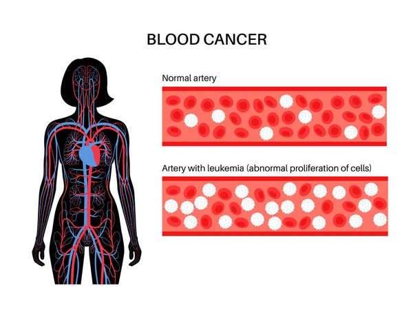 Nemoc rakoviny leukémie — Stockový vektor