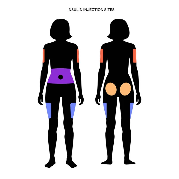 Insulin injektionsställen — Stock vektor
