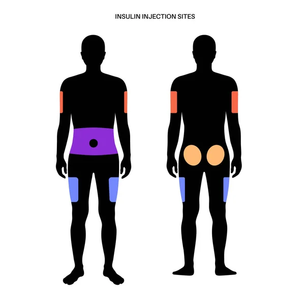 Lugares de inyección de insulina — Vector de stock