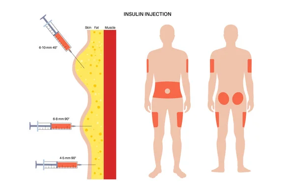 Lugares de inyección de insulina — Archivo Imágenes Vectoriales