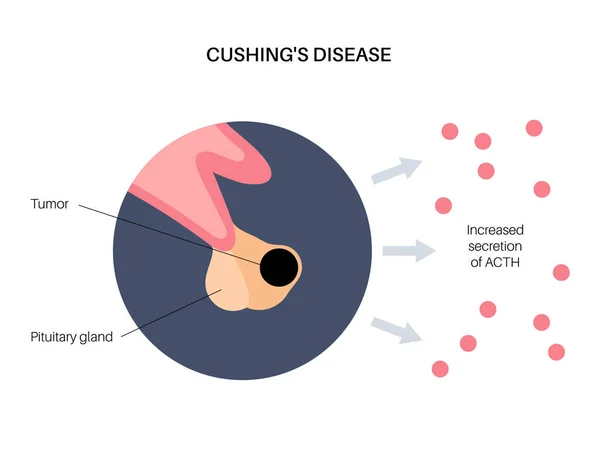 Cushing betegség plakát — Stock Vector