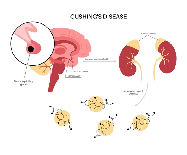 Poster voor de ziekte van Cushing — Stockvector