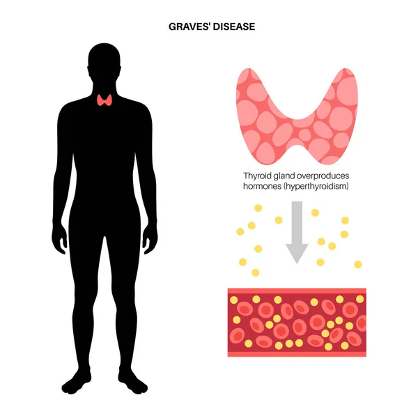 Graven desease symptomen — Stockvector