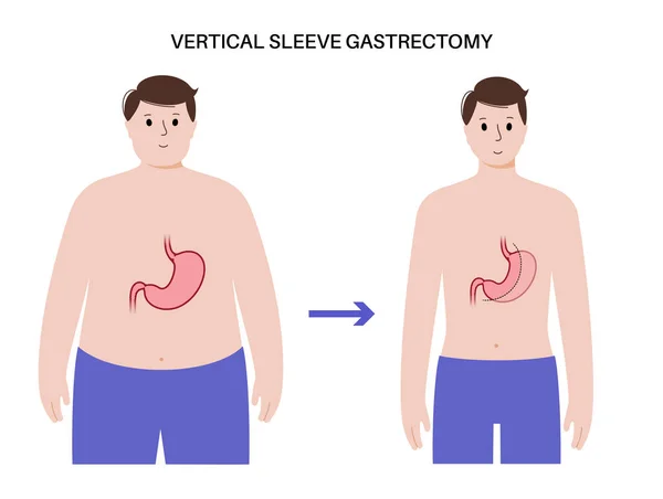 腹腔鏡下袖胃切除 — ストックベクタ