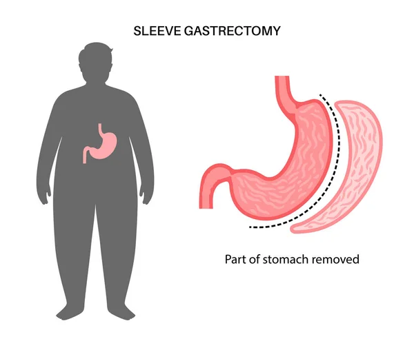 Gastrectomie de la manche laparoscopique — Image vectorielle