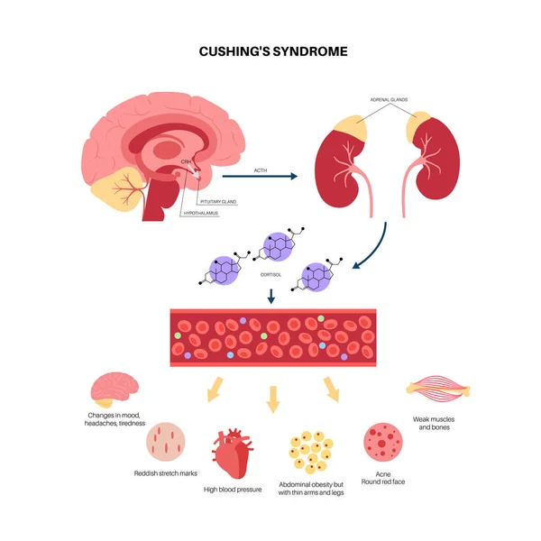 Poster voor de ziekte van Cushing — Stockvector