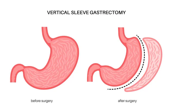 Gastrectomía de manga laparoscópica — Archivo Imágenes Vectoriales