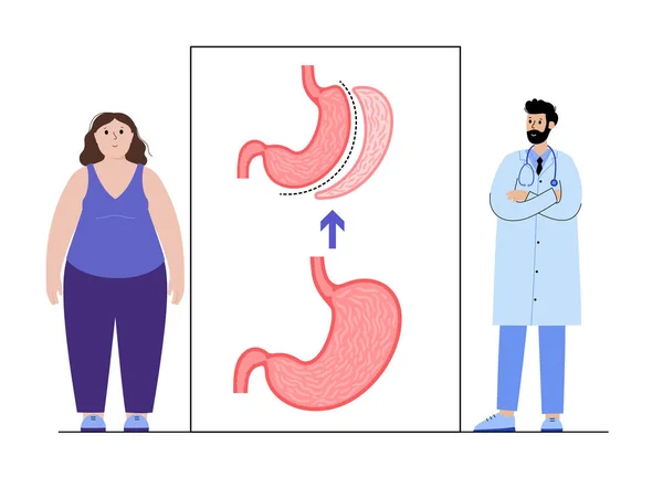 Gastrectomie de la manche laparoscopique — Image vectorielle