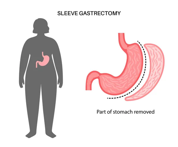 腹腔鏡下袖胃切除 — ストックベクタ