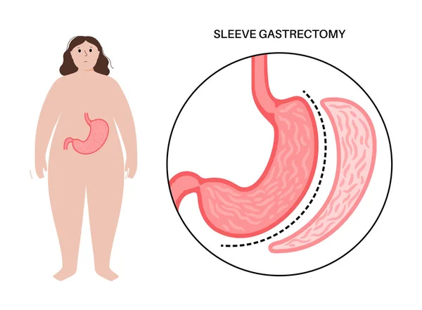 Лапароскопическая рукавная гастрэктомия — стоковый вектор