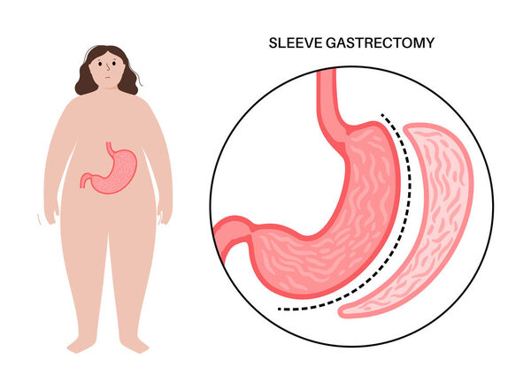Laparoscopic sleeve gastrectomy