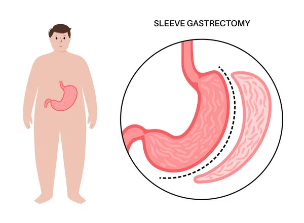垂直スリーブ胃洗浄 肥満の男性のシルエット 胃の手術 減量胃の手順 腹腔鏡の概念 人間の体の過体重の問題 フラットベクトル医療イラスト — ストックベクタ