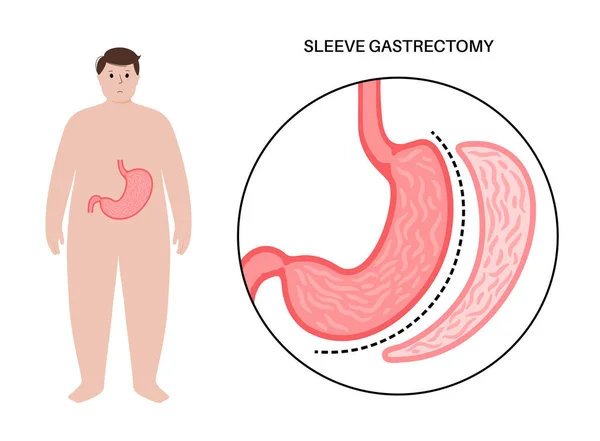 Pionowa Gastrektomia Rękawa Męska Sylwetka Otyłością Operacja Żołądka Utrata Masy — Wektor stockowy